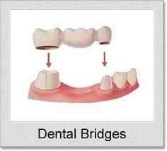 dentalbridges
